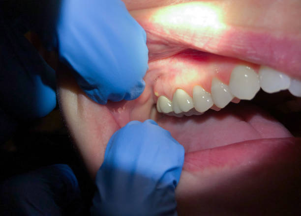 Best Emergency Wisdom Teeth Removal in Yutan, NE